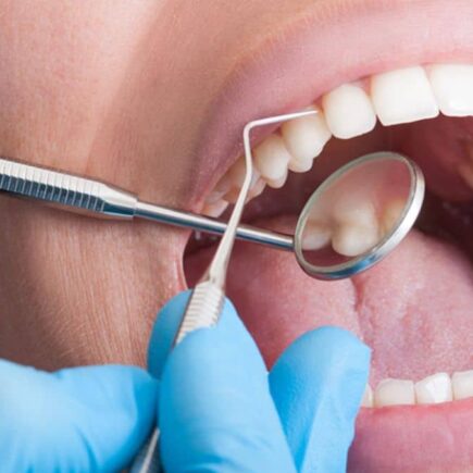 How to Know If I Need a Root Canal Treatment